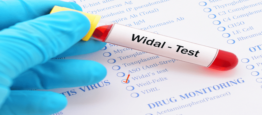 Principle and Procedure Widal Test