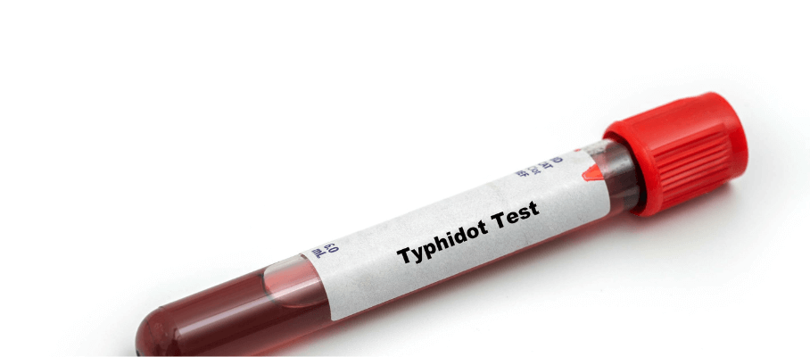 Typhidot Test & Report