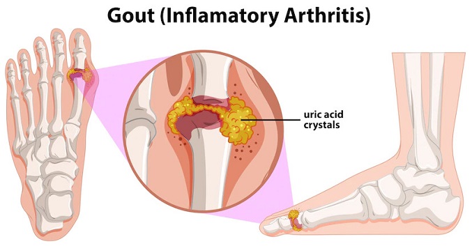 How To Interpret Your Uric Acid Levels