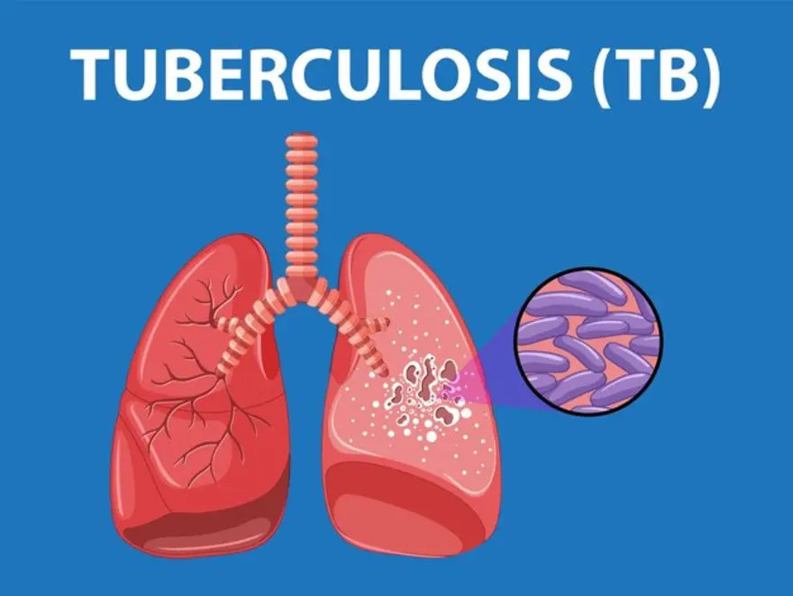 Origins, Signs, and Remedies of TB