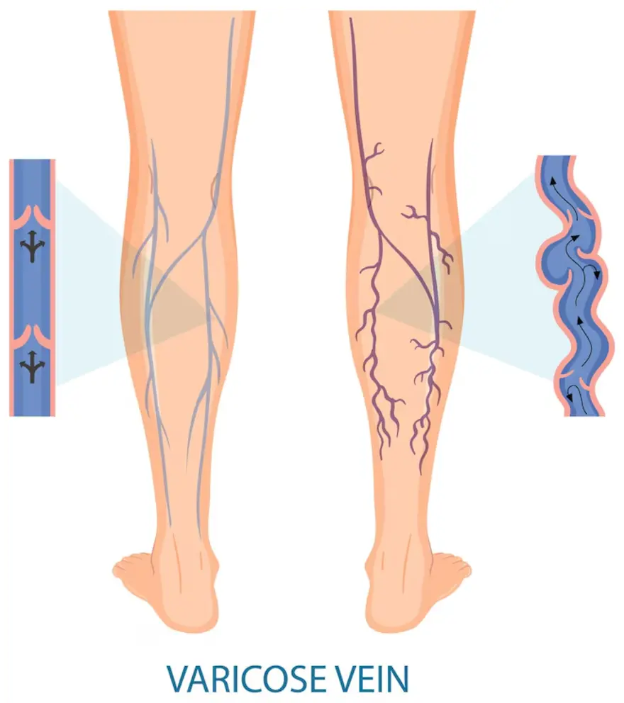 Symptoms, Causes, Diagnosis of Varicose Veins